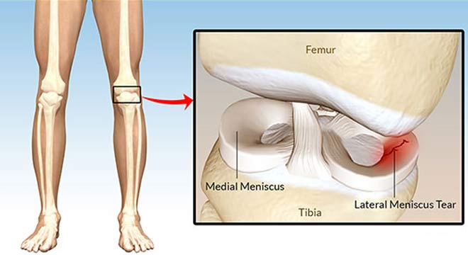 علائم و درمان پارگی منیسک در مفصل زانو