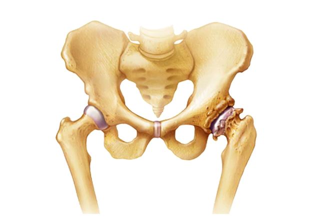 علت بروز ساییدگی مفصل یا استئوآرتریت بدنبال شکستگی استخوان چیست