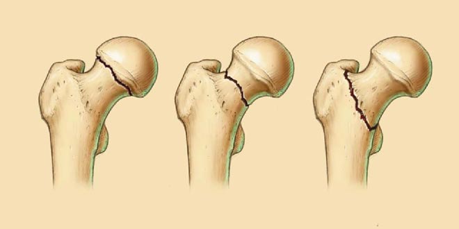 شکستگی مفصل ران یا شکستگی هیپ چیست. علائم و نحوه درمان