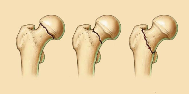 Перелом шейки бедра картинка рисунок. Строение тазобедренного травмы. Femur Breaker. Где находится шейка бедра у женщины фото. Отек шейки бедра