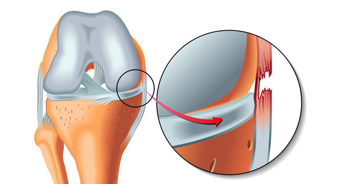 پارگی رباط جانبی زانو