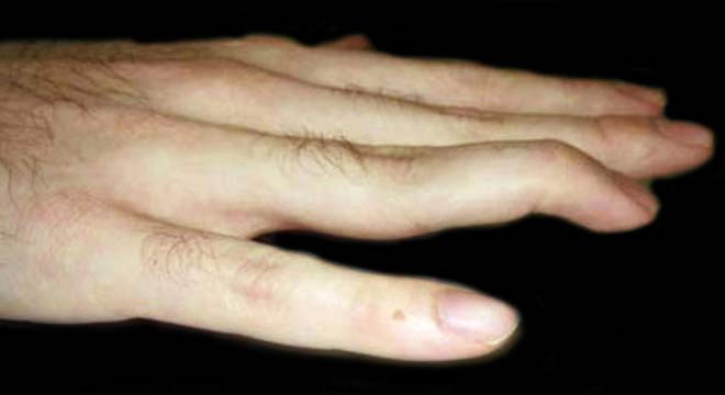 انگشت چکشی (مالت فینگر) دست چیست