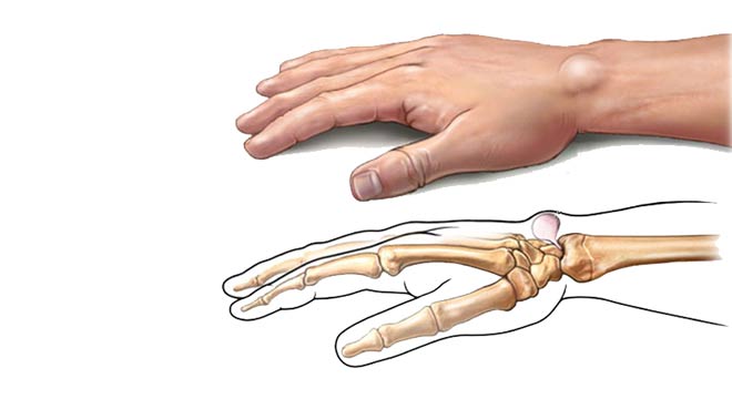 گانگلیون مهمترین علت برجستگی پشت مچ دست چگونه درمان میشود
