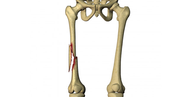 شکستگی تنه استخوان ران در بالغین چگونه درمان میشود