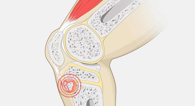 آیا درد روی برجستگی زیر زانو به علت بیماری ازگود اشلاتر است
