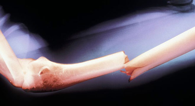 شکستگی تنه استخوان بازو در یک مرد جوان