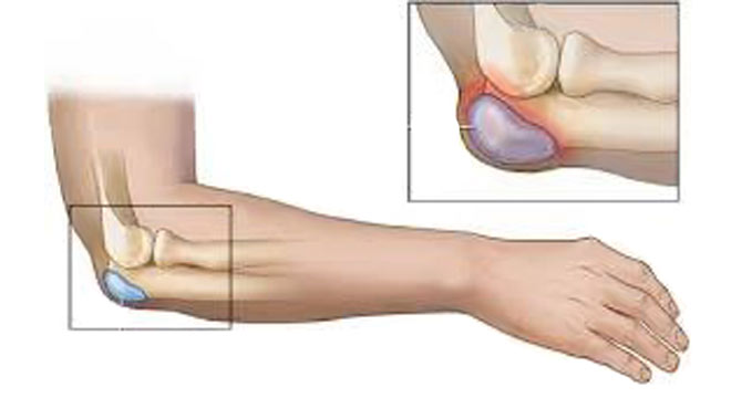 بورسیت اولکرانون چیست. علت درد و تورم پشت مفصل آرنج چیست