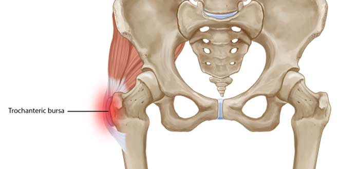 بورسیت تروکانتر لگن