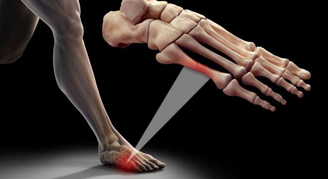 انواع شکستگی های کف پا کدامند و چگونه درمان میشوند