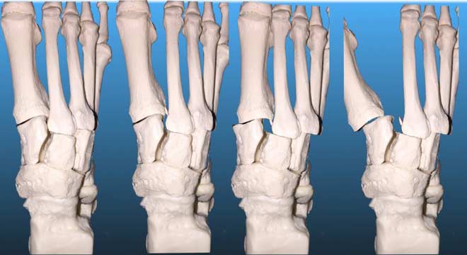 شکستگی لیسفرانک در ناحیه کف پا چیست