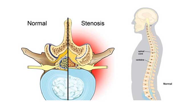 تنگی کانال نخاعی کمر