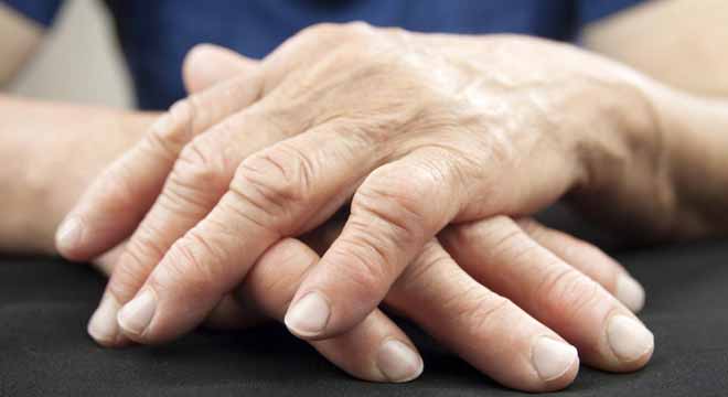 آرتریت دست چیست و چگونه درمان میشود