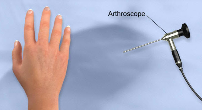 آرتروسکوپی مچ دست