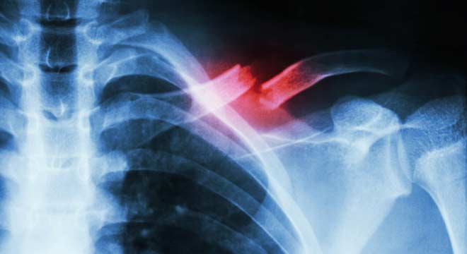 جوش نخوردن شکستگی استخوان چگونه ایجاد میشود و درمان آن چیست