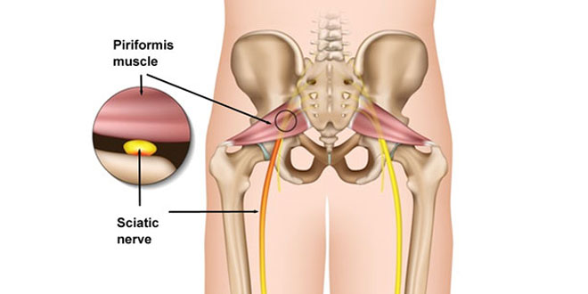 سندروم پیریفورمیس از علل مهم درد پشت لگن و باسن است (تشخیص و درمان)