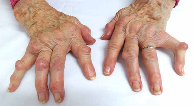 آرتریت انگشت دست چیست. علائم و درمان