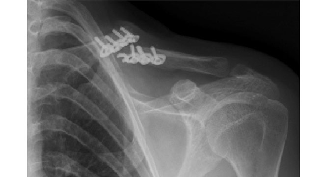 شکستگی پیچ و پلاک (پلاتین) استخوان بعد از جراحی. علت و درمان