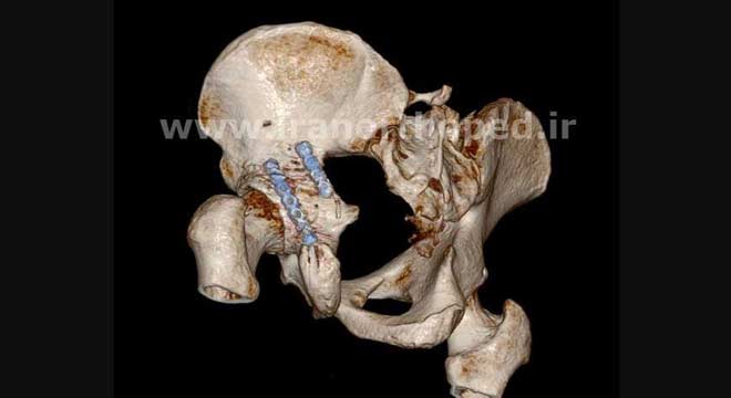 شکستگی ستون و لب خلفی استابولوم. بررسی تخصصی نمونه دوم