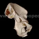 شکستگی ستون قدامی استابولوم لگن
