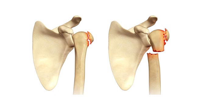 شکستگی گردن استخوان بازو