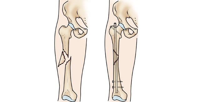 شکستگی استخوان ران