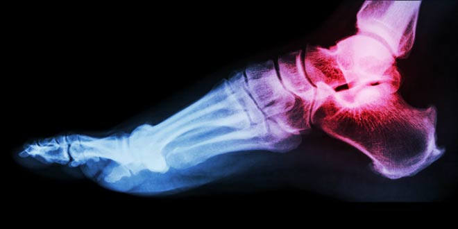 علت عفونت استخوان بعد از شکستگی چیست