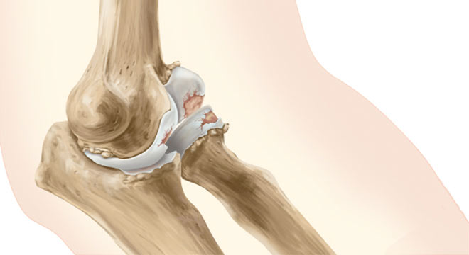 آرتروز یا ساییدگی مفصل آرنج چگونه ایجاد شده و چه علائم و درمانی دارد