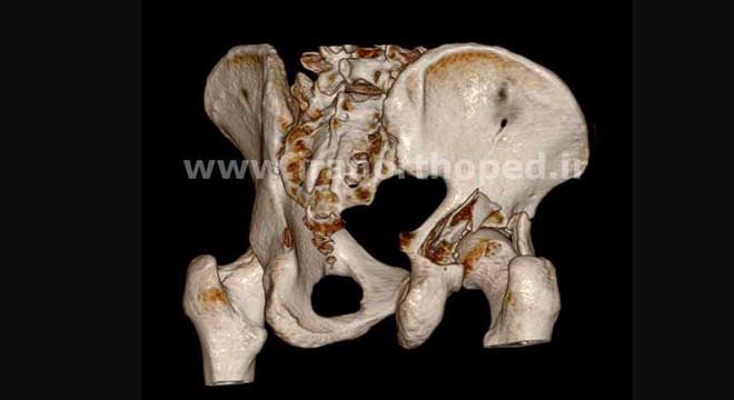 شکستگی لب خلفی استابولوم لگن