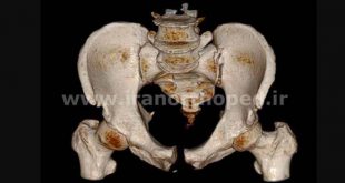 دررفتگی سمفیز پوبیس