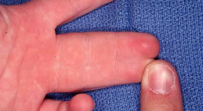 سین داکتیلی یا چسبیده بودن مادرزادی انگشتان دست چیست