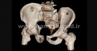 دررفتگی سمفیز پوبیس و مفصل ساکروایلیاک لگن