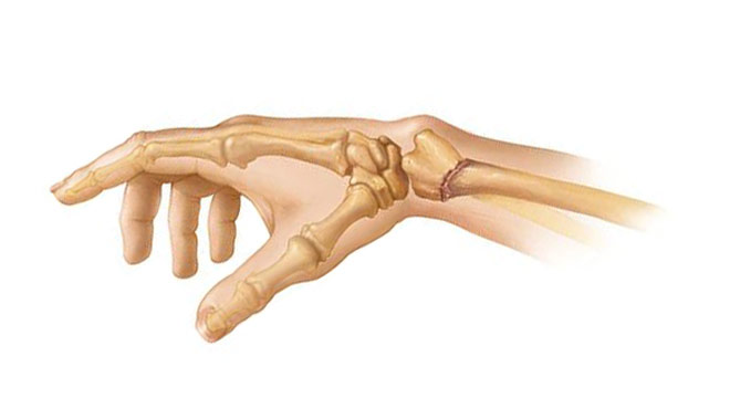 شکستگی مچ دست (کالیس). علائم و درمان