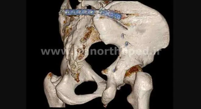 شکستگی ساکروم و استابولوم