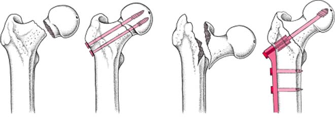 درمان جراحی شکستگی گردن استخوان ران - لگن