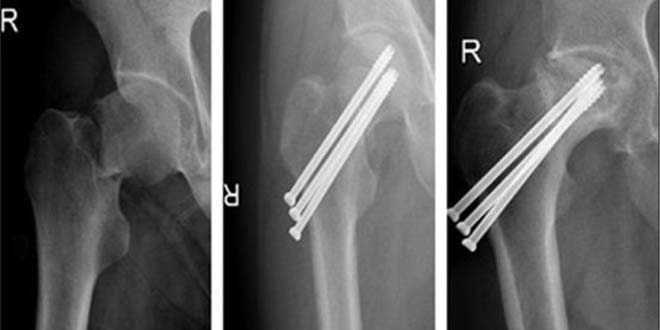 عوارض شکستگی گردن استخوان ران - لگن