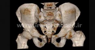 دررفتگی سمفیز پوبیس و مفصل ساکروایلیاک لگن