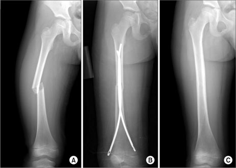 شکستگی تنه استخوان ران در یک پسر ۸ ساله