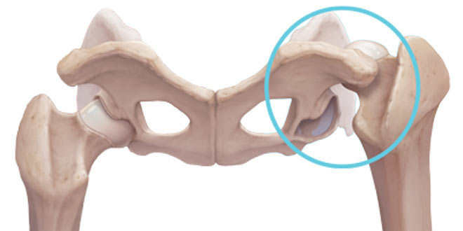 دررفتگی مفصل ران (هیپ) در ناحیه لگن بدنبال ضربه. علل، علائم و درمان