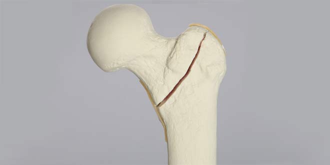 شکستگی اینترتروکانتریک استخوان ران. تشخیص و روش درمان