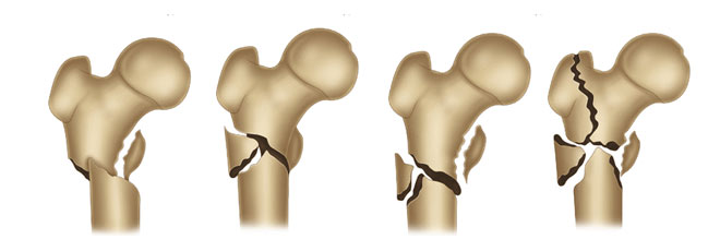 شکستگی لگن در ناحیه ساب تروکانتریک استخوان ران چیست و چگونه درمان میشود