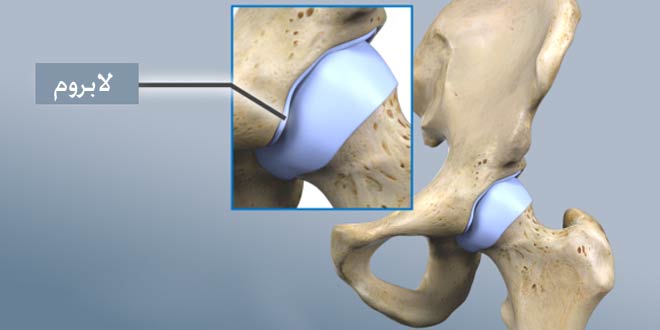 لابروم در مفصل ران