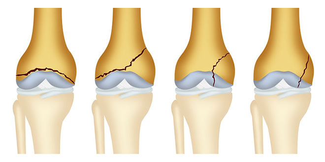 شکستگی انتهای پایینی استخوان ران چگونه درمان میشود