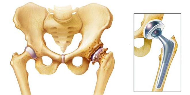 آیا آرتروز و ساییدگی مفصل ران نیاز به عمل جراحی تعویض مفصل لگن دارد