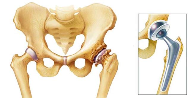 درمان آرتروز مفصل لگن