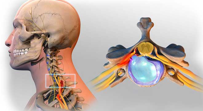 علائم و درمان هرنی یا فتق دیسک بین مهره ای گردن چیست