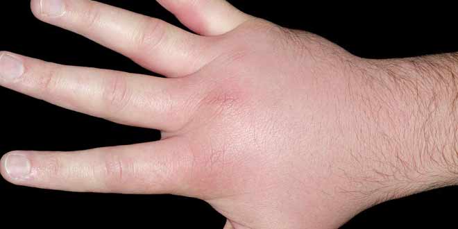 سلولیت یا عفونت سطحی پوست دست چگونه درمان میشود