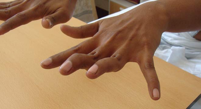 دفرمیتی سوان نک یا تغییر شکل گردن قو در انگشت دست چیست