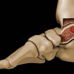 درمان تومور استخوان