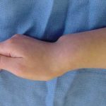 مادلانگ دفرمیتی در مچ دست