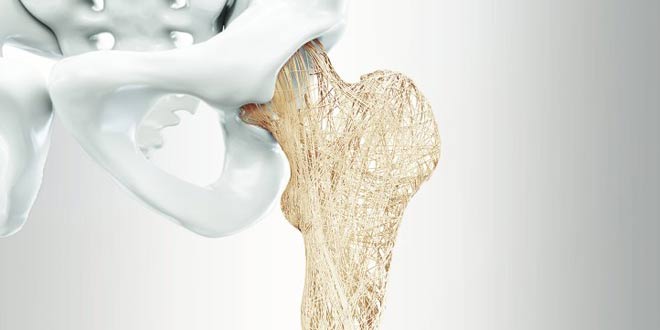 چه عواملی موجب افزایش احتمال شکستگی لگن در مفصل ران میشوند